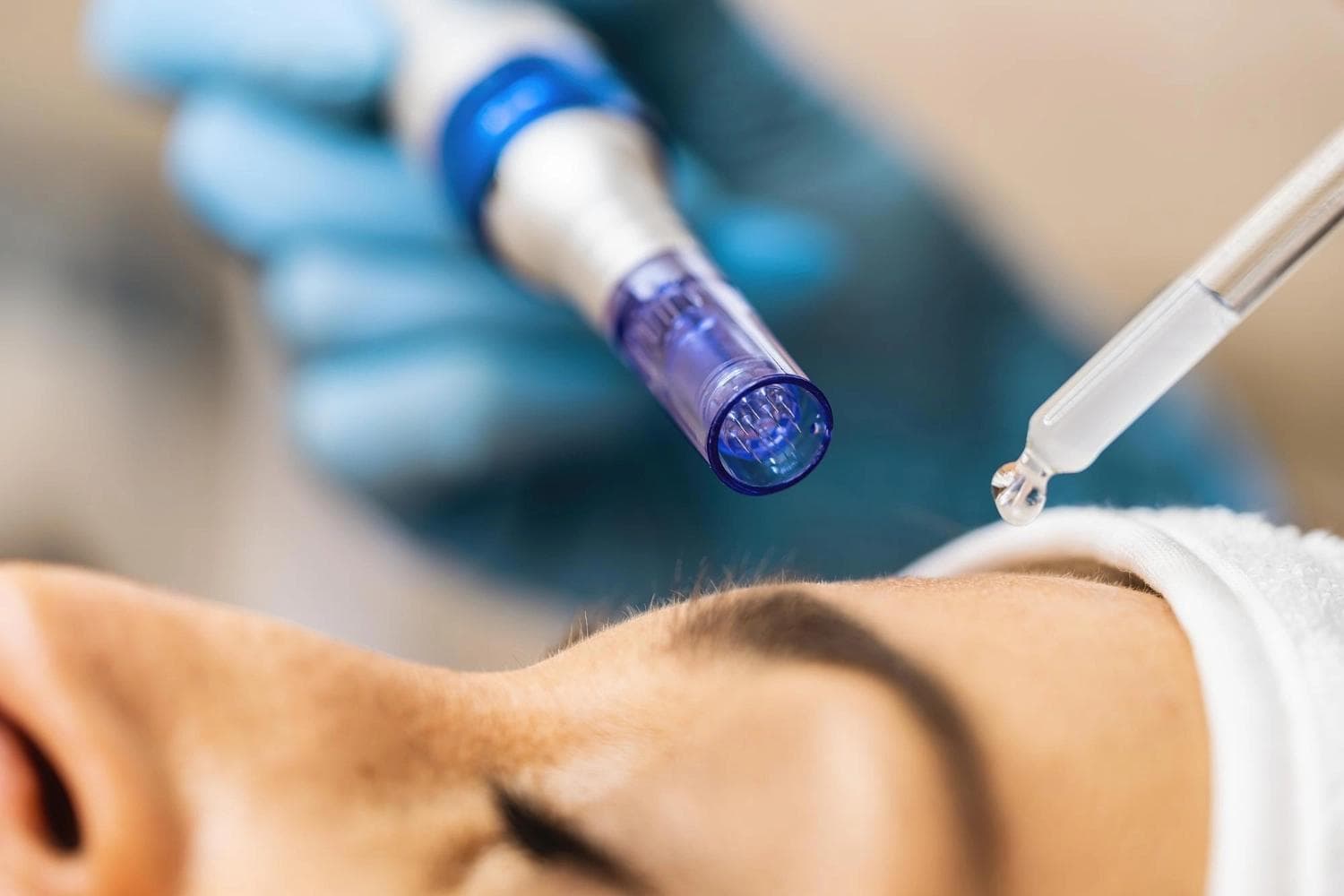 Nahaufnahme einer Microneedling-Behandlung in Berlin mit einem professionellen Hautnadelgerät und Serum
