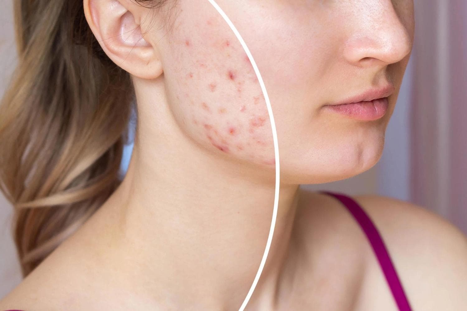 Close-up of a woman’s cheek showing before and after results of an acne peel treatment, with visibly reduced inflammation and clearer skin